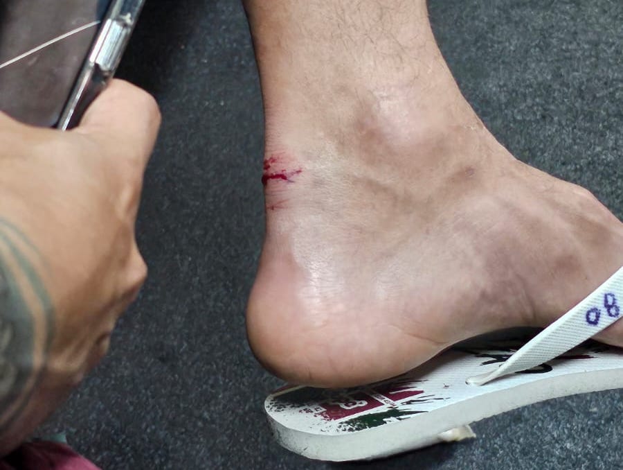 Veja como ficou tornozelo de Germ&aacute;n Cano ap&oacute;s lance do primeiro gol do Vasco sobre o Fluminense (Foto: Reprodu&ccedil;&atilde;o)